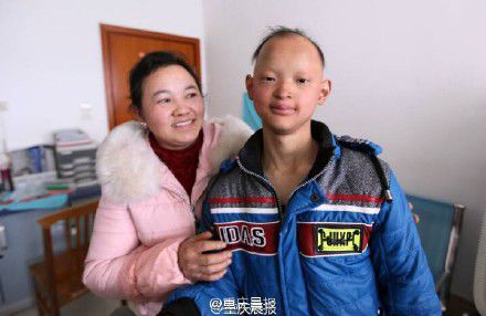 少年患病似吸血鬼先天性外胚层发育不良的遗传性疾病2