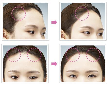 请记住:女神颜值毁于发际线