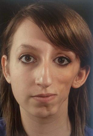 美10岁女孩患罕见疾病脸部塌陷家人为其筹钱