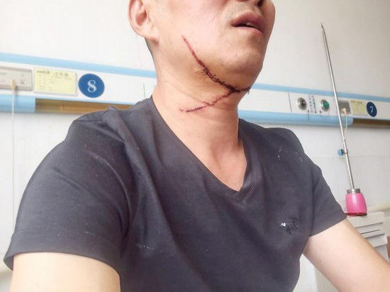 淮安一路人遭风筝线"割喉" 缝了14针