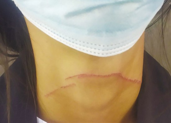 市民脖子被风筝线割伤.